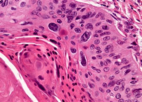 Hypopharyngeal cancer and nasopharyngeal cancer are rare. Laryngeal Squamous Cell Carcinoma at 10x Magnification ...