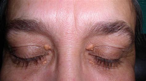 How To Remove Cholesterol Deposits On Eyelids At Home