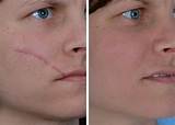 Images of Acne Scar Laser Treatment Nyc