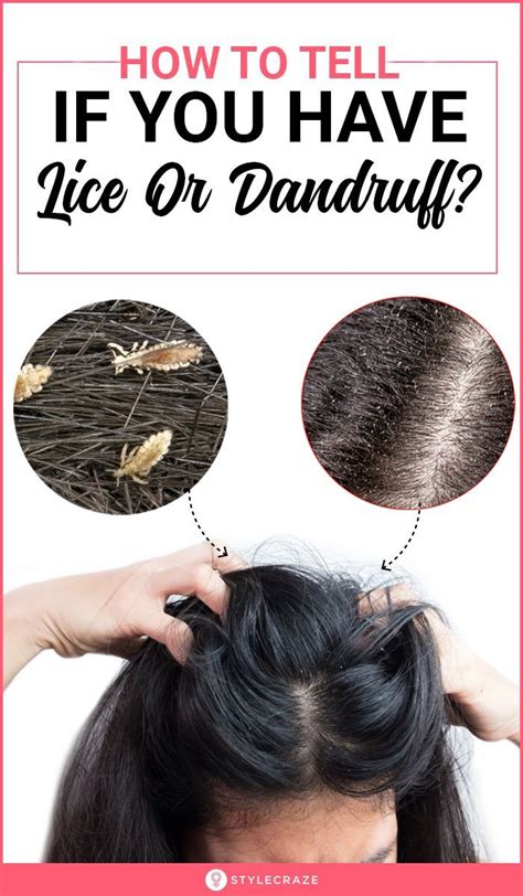 How To Identify Lice Vs Dandruff
