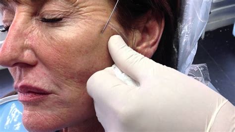 Thread Lift Facial Surgery Adult Archive Comments