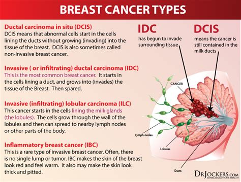 How Common Is Inflammatory Breast Cancer 2022