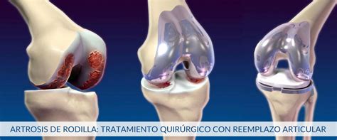 Marco De Referencia Tablero Hacia Arriba Rehabilitacion Para Artrosis