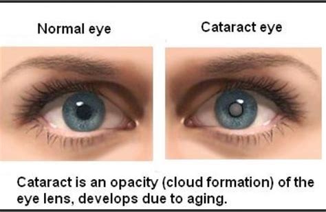 Cataract Surgery Do You Have Cataract Royal Spanish Center