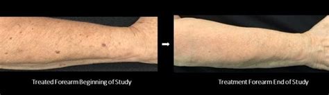 Dr Siperstein Studies New Treatment For Forearm Bruising Siperstein