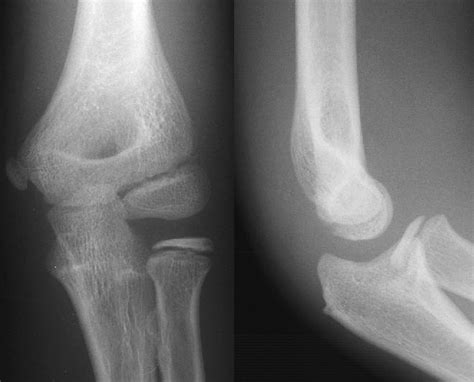 Fibromyalgia and Bone Health - My Fibromyalgia Diet