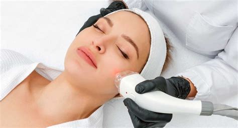 Laser Hair Removal Sideburns Permanent Removal