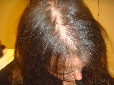 Women typically have a broadening of the part in their hair. Treatment For Female Pattern Baldness (Options That Work ...