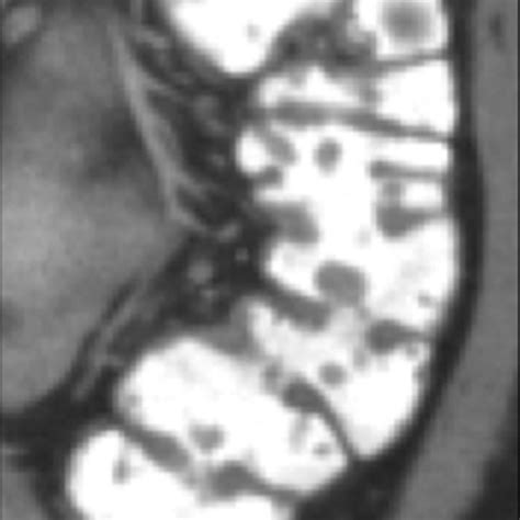 Computed Tomography Of The Abdomen And Pelvis With Oral And Intravenous