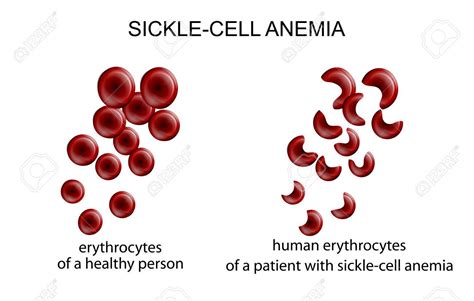 Sickle Cell Anemia