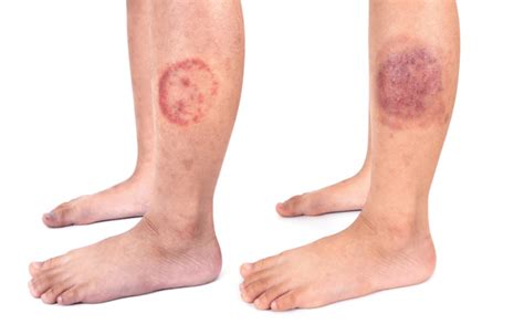Difference Between Nummular Eczema And Ringworm Our Eczema
