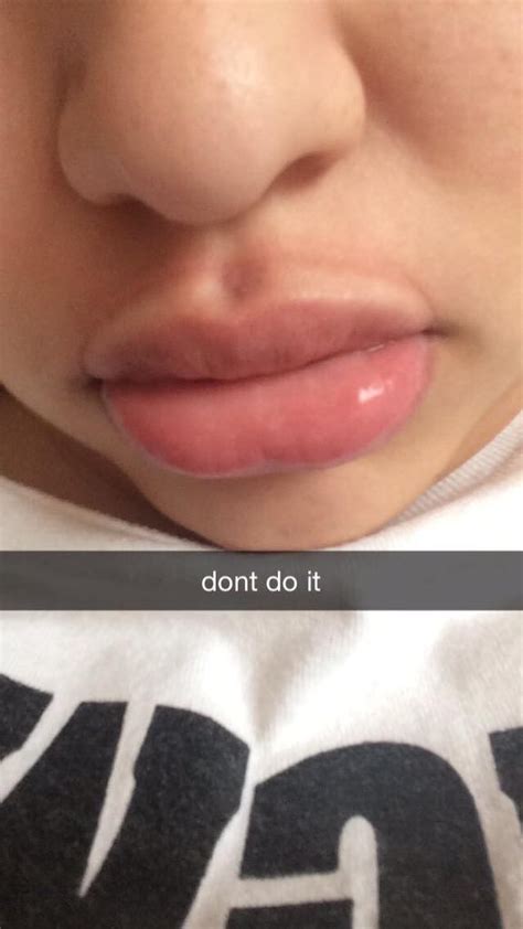No Surprise The Kylie Jenner Lip Challenge Is An Epic Fail