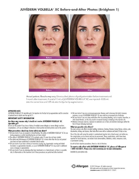 Fillers For Lips In New Jersey Soma Skin And Laser