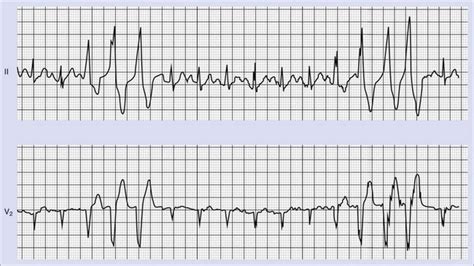Nonsustained Ventricular Tachycardia Thoracic Key