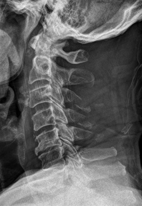 Spinous Process Fractures C3 C5 Radiology Case