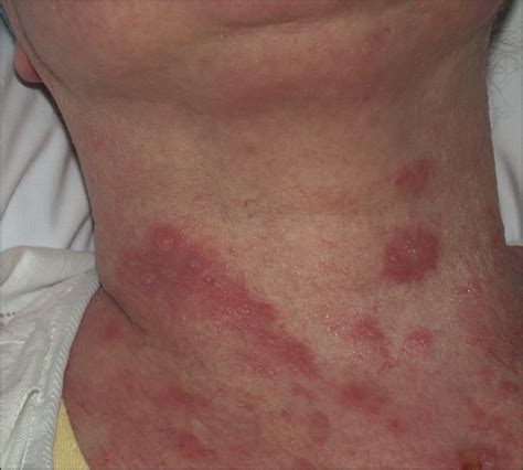 Vorinostat For The Treatment Of Bullous Pemphigoid In The Setting Of
