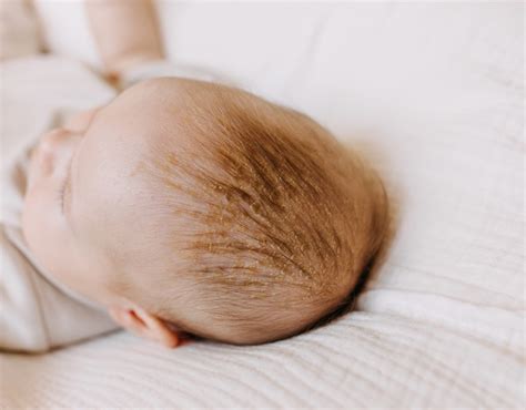 Cradle Cap On Your Babys Face Causes And Treatment