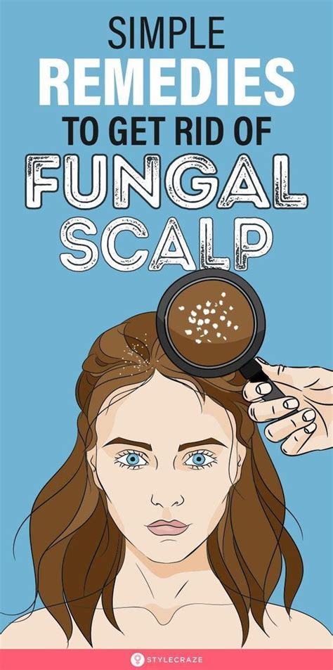 8 Home Remedies To Get Rid Of Scalp Fungus Prevention Tips Artofit