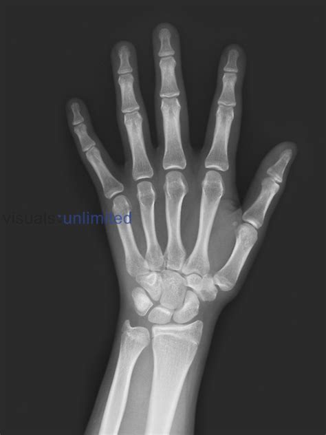 Normal Hand X Ray Of An 18 Year Old Female Visuals Unlimited