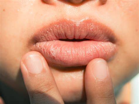 Major Causes Of Chapped Lips And How To Treat Them Self