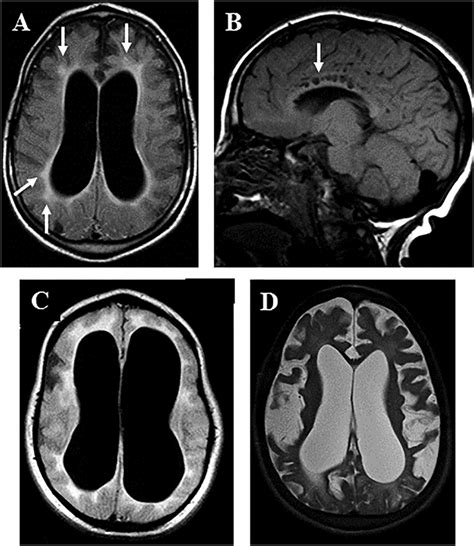 Anatomical Changes In The Brain Of Mps Patients A Moderate White