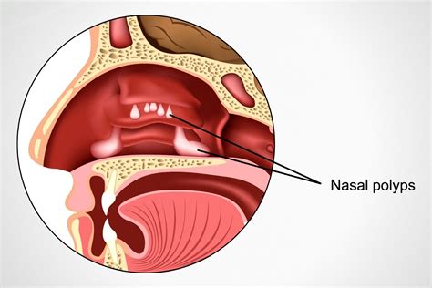 Nasal Polyps Nulife Hospital Gastroenterology Liver Diseases