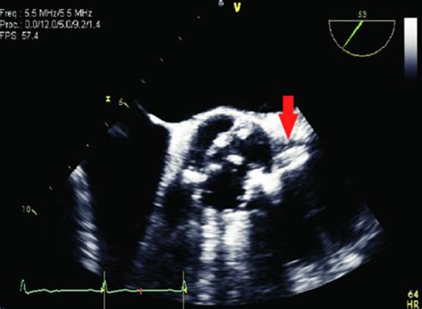 Echocardiography Test 1 Flashcards Quizlet