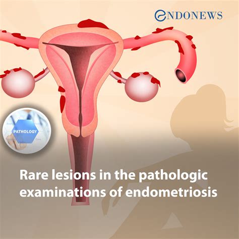 Rare Lesions In The Pathologic Examinations Of Endometriosis Endonews