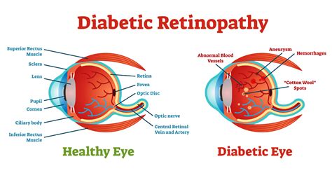 Diabetes interferes with the body's ability to use and store sugar (glucose). Diabetic Retinopathy Basics
