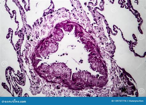 Lung Emphysema Light Micrograph Stock Photo Image Of Disease