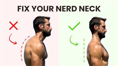 Fixing Forward Head Posture Opt In Page — Aaron Alexander