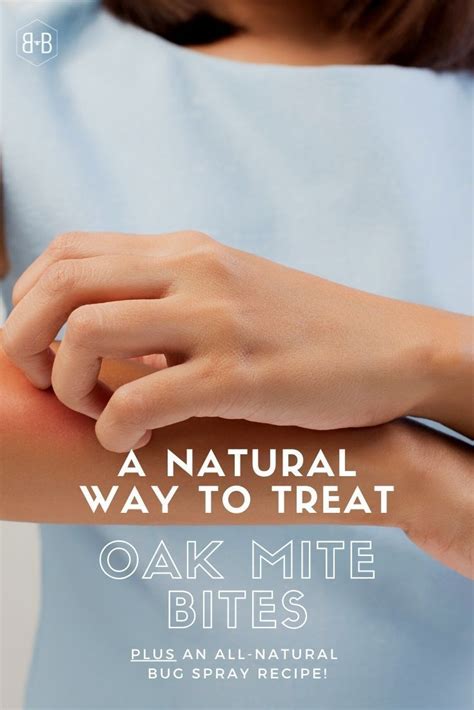 How To Treat Oak Mite Bites • Bee And Basil In 2020 Oak Mites Oak