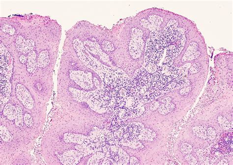 Pathology Outlines Verruciform Xanthoma