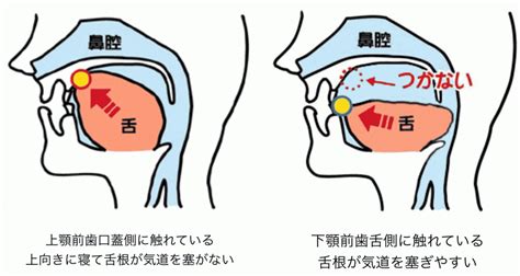 舌癖と舌癖のトレーニング 名古屋市栄の矯正専門医なら大山矯正歯科