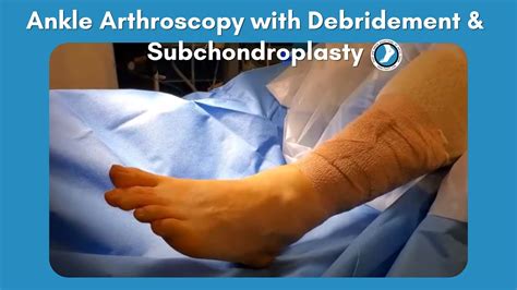 Ankle Arthroscopy With Debridement And Subchondroplasty Youtube