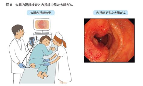 The site owner hides the web page description. 大腸 が ん 大腸 癌 便 の 色 写真 - Hello Doctor