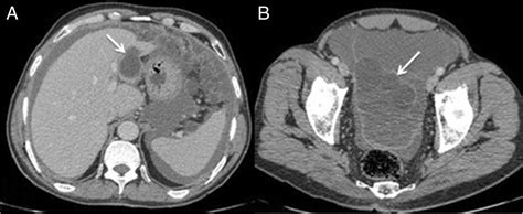 Spontaneous Intraperitoneal Rupture Of Hepatic Hydatid Cyst A Rare