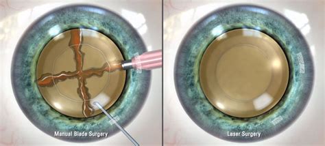 Cataract Surgery Ventura County Eye Health Dlv Vision