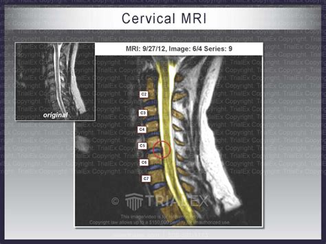 Cervical Mri Trial Exhibits Inc