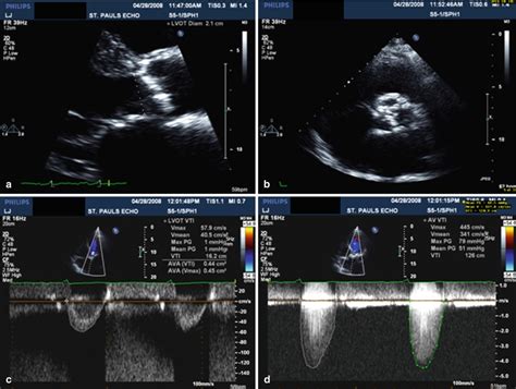 Echocardiographic Evaluation Of Aortic Stenosis Radiology Key