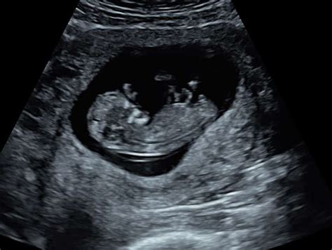Early Pregnancy Scans Explained Firstscan At Window To The Womb