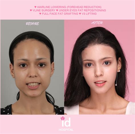 Full Plastic Surgery Makeover In Id Hospital 🌸 In 2023 Forehead