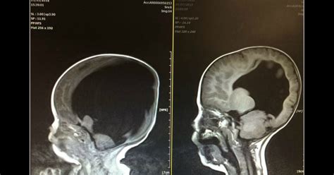 Miracle Boy Born With Virtually No Brain Function Noah Wall Recovery