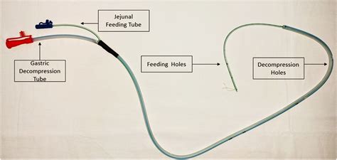 Improvised Dual Lumen Nasojejunal Feeding Tube With Gastric