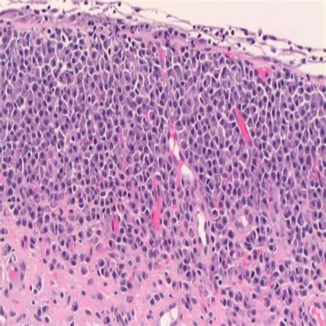 Cureus A Case Of Mucosa Associated Lymphoid Tissue Lymphoma Of The