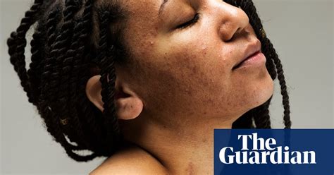 Behind The Makeup Women Defy The Stigma Of ‘imperfect Skin In