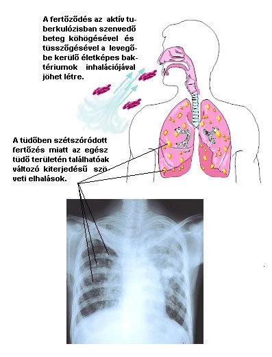 A Tuberkulózis Tbc Tünetei és Rizikófaktorai Webbeteg