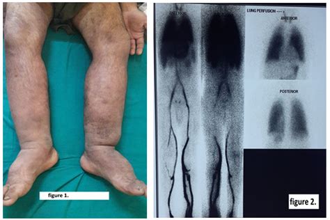 Primary Lymphedema International Journal Of Clinical And Medical Images