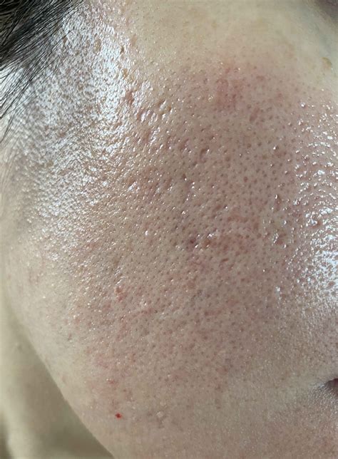 What Are The Treatments I Can Go Through For Oily Skin Large Pores Acne Scars And Small Bumps