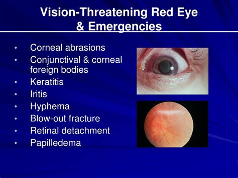 Ppt The Red Eye And Selected Ocular Emergencies Powerpoint